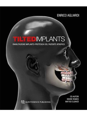 Tilted implants. Riabilitaz...