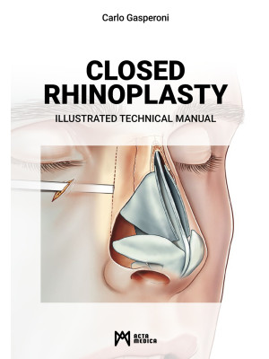 Closed rhinoplasty. Illustr...