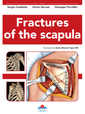 Fractures of the scapula. E...