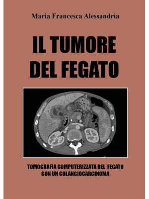 Il tumore del fegato