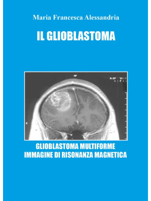 Il glioblastoma